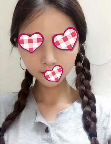 北京葉子整形膨體隆鼻術(shù)后一個(gè)月效果