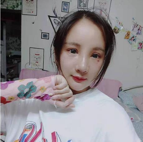 天津文怡整形水光針注射一周