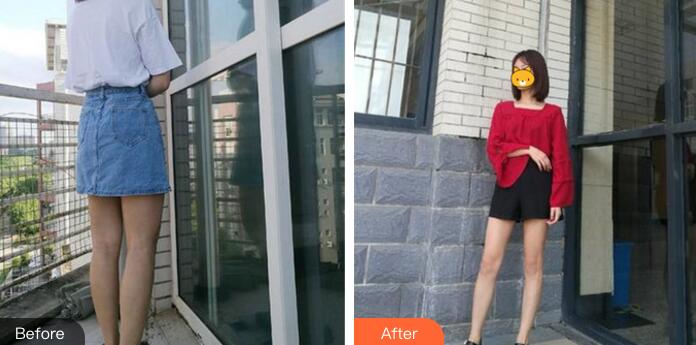 中山美南華整形大腿吸脂前后對比圖