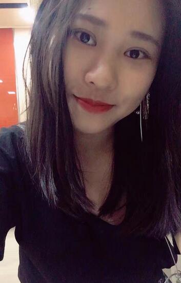 肇慶華美整形切開雙眼皮術后三個月