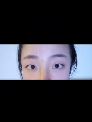 西安時光整形郭淑華雙眼皮案例分享，一個月就這么自然