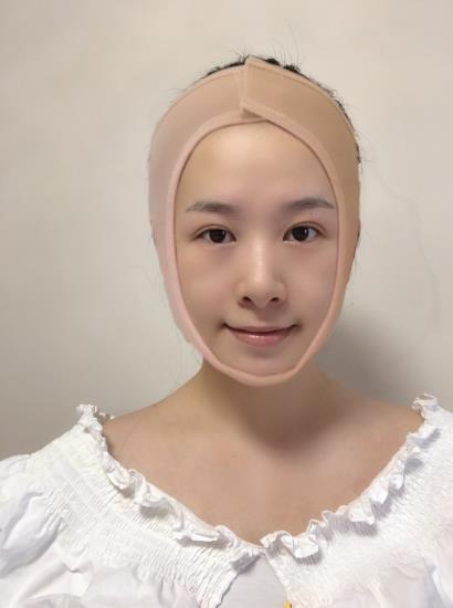 南方醫(yī)院整形美容科顴骨內推術后一周