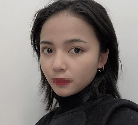 長沙愛思特整形定點雙眼皮案例分享，蘿莉到御姐的轉(zhuǎn)變