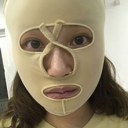 重慶美聯(lián)臣下頜角整形半個(gè)月效果