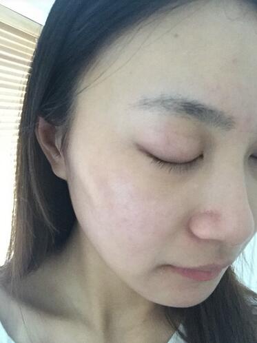 合肥艾雅整形紅藍(lán)光祛痘兩個(gè)療程結(jié)束后效果