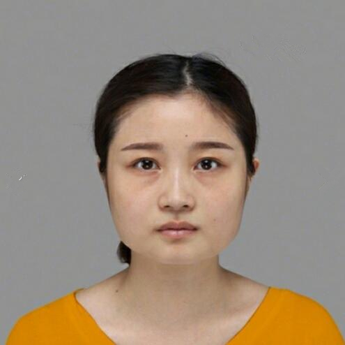 重慶美聯(lián)臣下頜角整形前