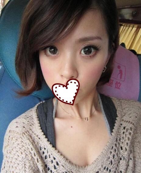 鄭州蘊(yùn)美整形玻尿酸隆鼻一周效果