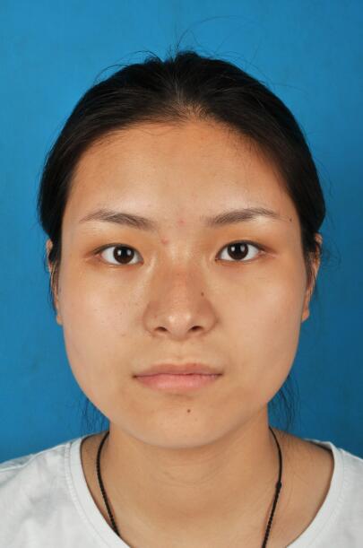 西安國際下頜角整形前