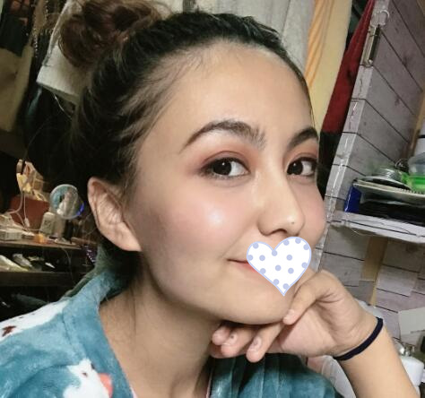 徐州時光洪揚整形雙眼皮術后一個月效果