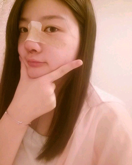 北京圣嘉榮二次鼻修復(fù)術(shù)后三天