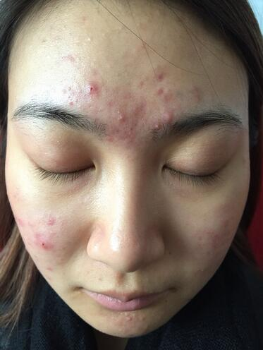 合肥艾雅整形紅藍(lán)光祛痘兩個療程效果，痘痘都消失了