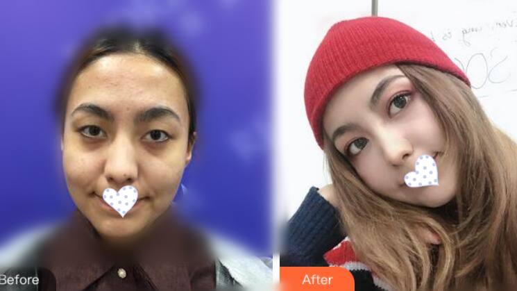 徐州時光洪揚整形雙眼皮案例前后對比圖