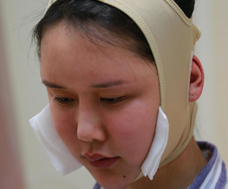 長沙亞韓整形陳明松下頜角整形術(shù)后十天 長沙亞韓整形陳明松下頜角整形術(shù)后十天