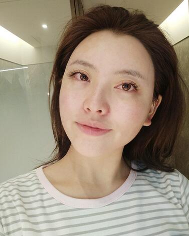 上海首爾麗格樸興植下頜角整形一個月 上海首爾麗格樸興植下頜角整形一個月