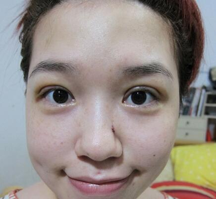 宜昌蕾帝整形張景雷雙眼皮十天效果