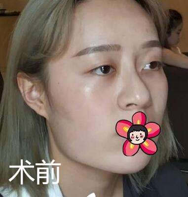 北京基礎(chǔ)美下頜角整形術(shù)前效果