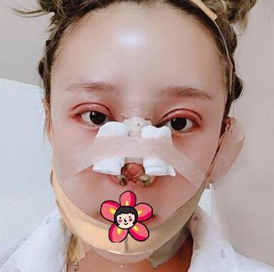 北京基礎(chǔ)美下頜角整形術(shù)后十天