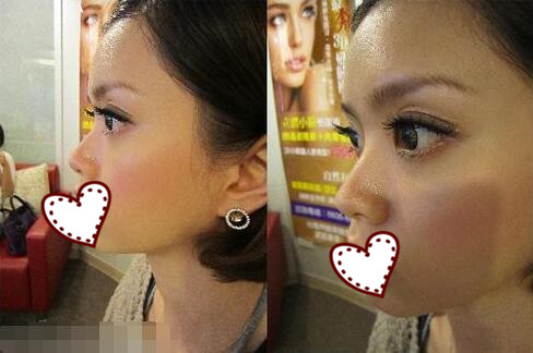 鄭州蘊(yùn)美整形玻尿酸隆鼻前