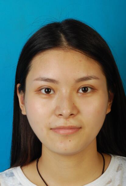 西安國際下頜角整形術(shù)后三個(gè)月正面效果