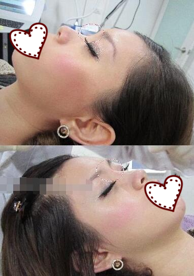 鄭州蘊(yùn)美整形玻尿酸隆鼻前后對比圖