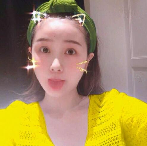 重慶美聯(lián)臣下頜角整形三個(gè)月效果