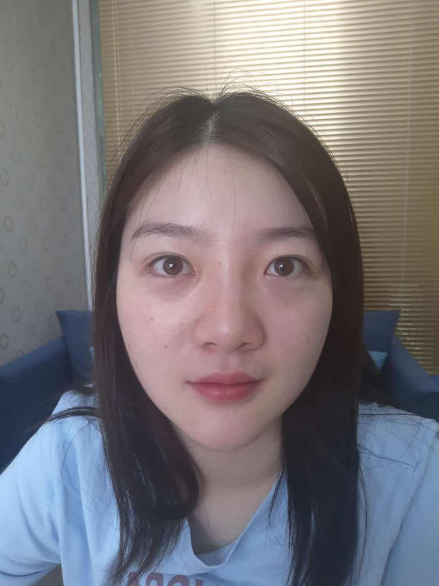 北京圣嘉榮二次鼻修復(fù)案例分享，做整形一定不要去莆田系醫(yī)院