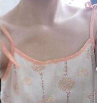 濟南悅美假體隆胸整形術(shù)前