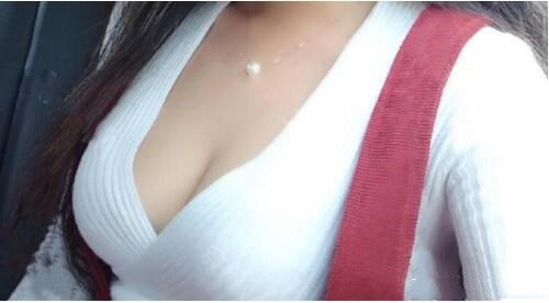 濟南悅美假體隆胸整形術(shù)后三個月效果