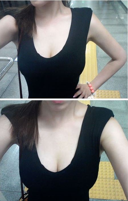 濟(jì)南鵬愛(ài)整形吳洪遠(yuǎn)復(fù)合隆胸三個(gè)月效果