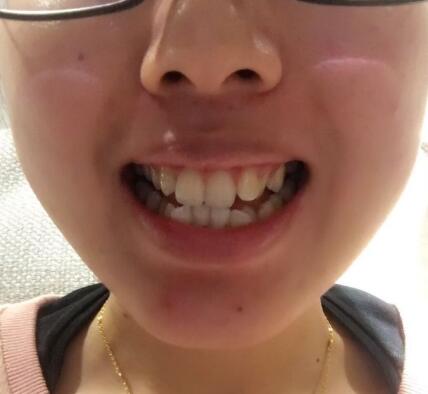 自貢華醫(yī)口腔金屬托槽矯正前