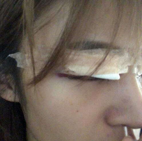 北京崔相平整形雙眼皮修復(fù)案例分享