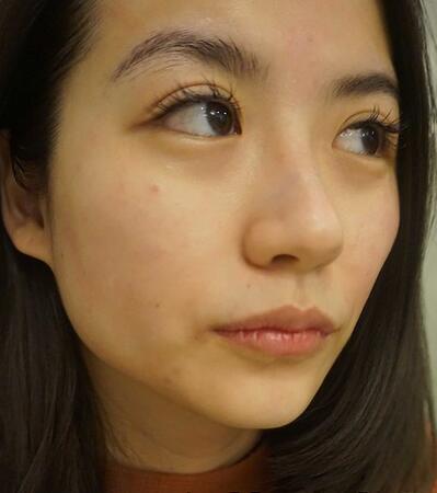 北京禾美嘉林善元激光祛斑術(shù)后一個(gè)月效果