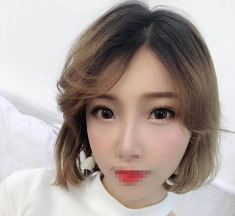 安徽省立醫(yī)院褚燕軍手術(shù)祛眼袋一個(gè)月效果 安徽省立醫(yī)院褚燕軍手術(shù)祛眼袋一個(gè)月效果