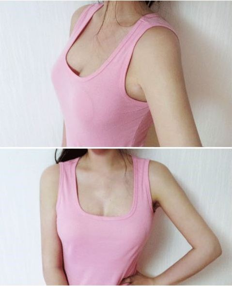 濟(jì)南鵬愛(ài)整形吳洪遠(yuǎn)復(fù)合隆胸兩個(gè)月效果