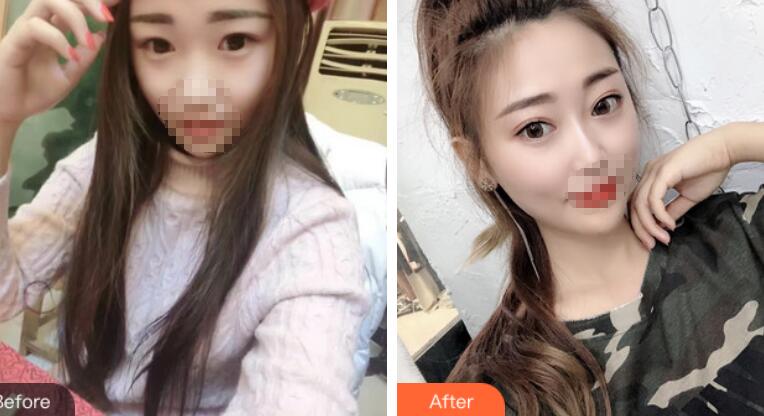 安徽省立醫(yī)院褚燕軍埋線雙眼皮前后對(duì)比圖 安徽省立醫(yī)院褚燕軍埋線雙眼皮前后對(duì)比圖