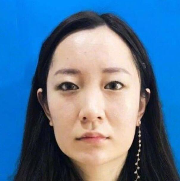 上海藝星整形崔海天下頜角整形案例分享