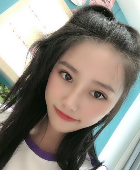 煙臺(tái)華怡整形張上海切開(kāi)雙眼皮一個(gè)月效果