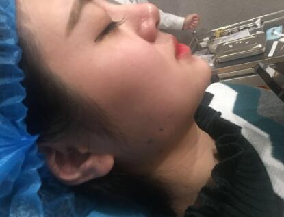 西安希美得整形瘦臉針瘦臉當天 西安希美得整形瘦臉針瘦臉當天