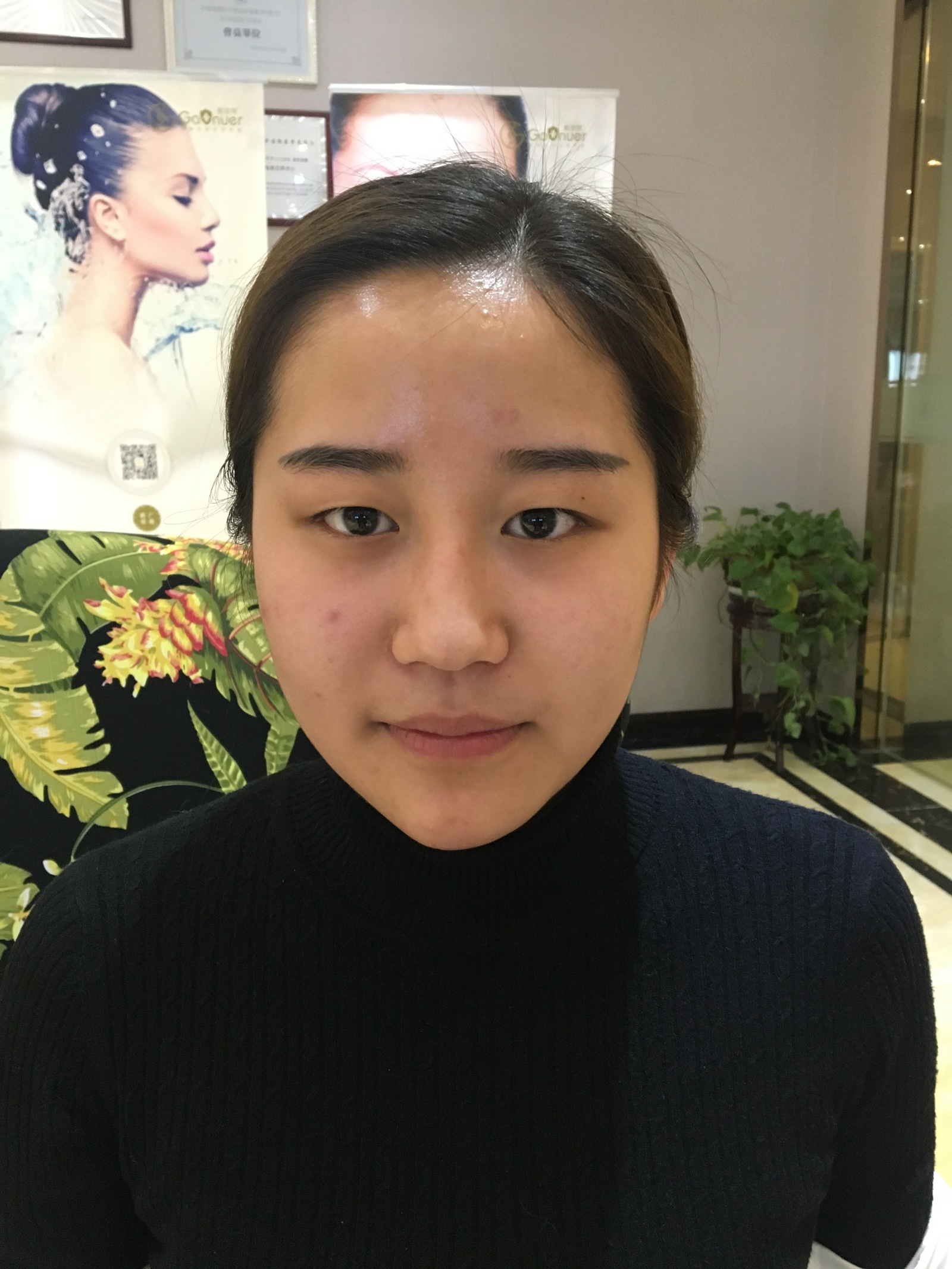 滄州中妤整形張明切開雙眼皮前