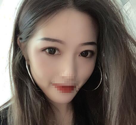 北京美萊整形杜園園雙眼皮三個月效果 北京美萊整形杜園園雙眼皮三個月效果