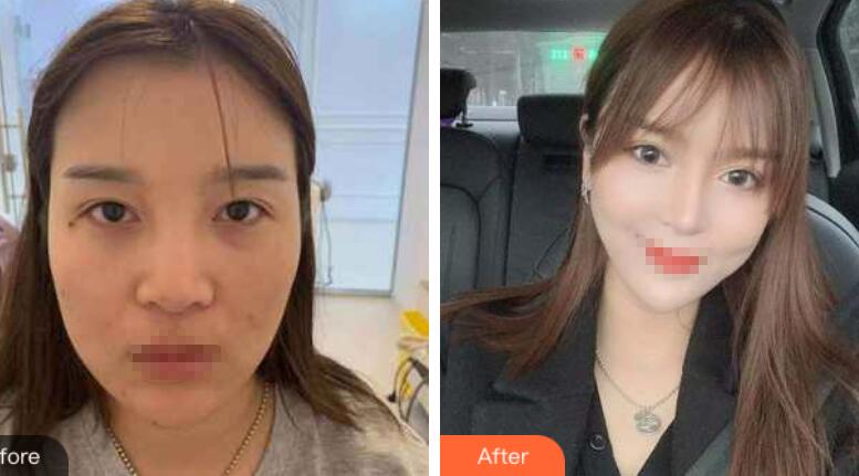 蘭州潤(rùn)妍整形鼻綜合前后對(duì)比圖