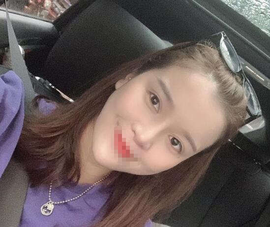 蘭州潤(rùn)妍整形鼻綜合術(shù)后四十天效果