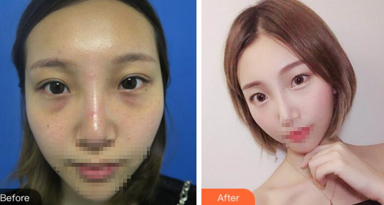 安徽省立醫(yī)院褚燕軍手術(shù)祛眼袋術(shù)后一個月效果分享