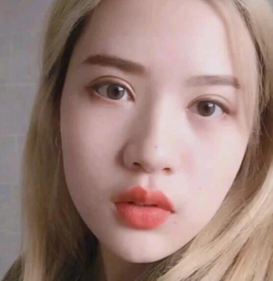 廣州中科美整形陳昌華雙下巴吸脂術(shù)后三個月效果 廣州中科美整形陳昌華雙下巴吸脂術(shù)后三個月效果