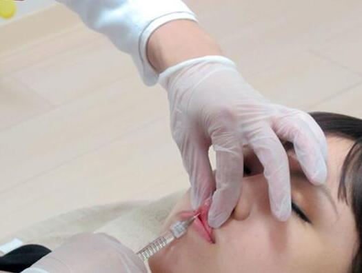 杭州藝涵整形玻尿酸豐唇中