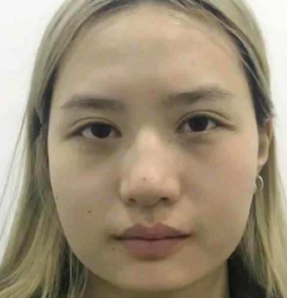 廣州中科美整形陳昌華雙下巴吸脂術(shù)前效果 廣州中科美整形陳昌華雙下巴吸脂術(shù)前效果