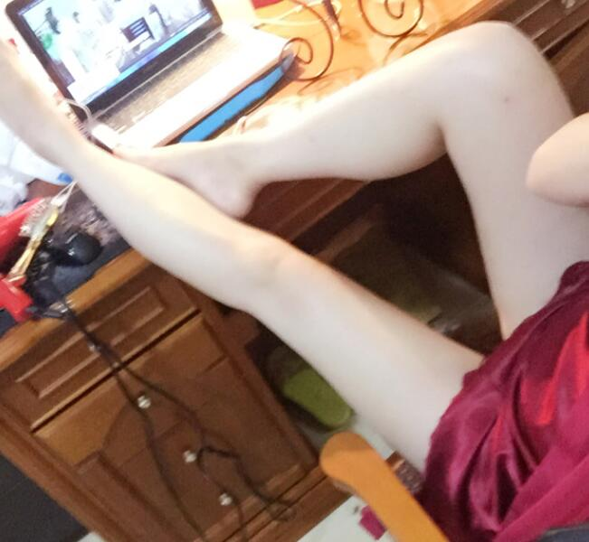 鄭州優(yōu)恩整形（原悅美）姚剛腿部吸脂案例分享