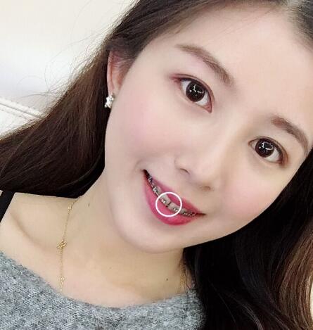 自貢華醫(yī)整形金屬托槽矯正即將結(jié)束