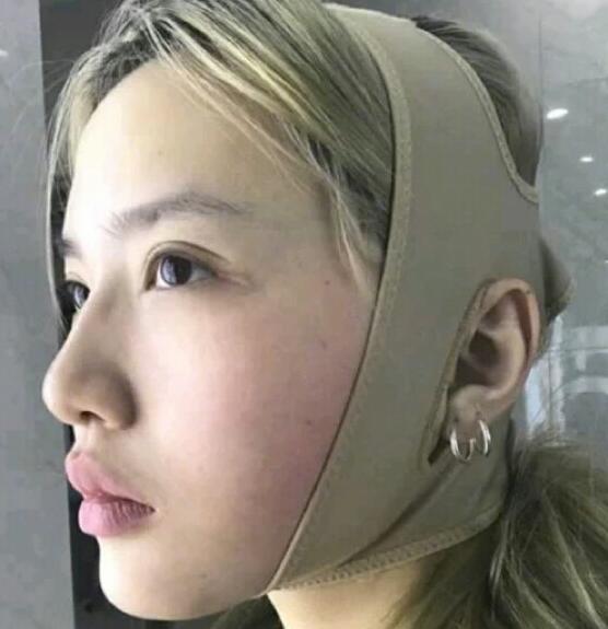 廣州中科美整形陳昌華雙下巴吸脂術(shù)后一周效果 廣州中科美整形陳昌華雙下巴吸脂術(shù)后一周效果