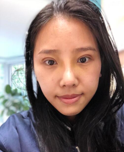 煙臺(tái)華怡整形張上海切開(kāi)雙眼皮拆線(xiàn)后